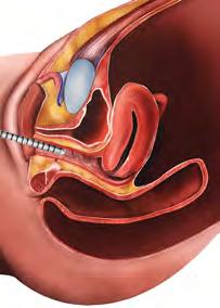 Ginekologia ʘ menopauzalny zespół moczowo-płciowy ʘ atrofia pochwy i przedsionka ʘ suchość