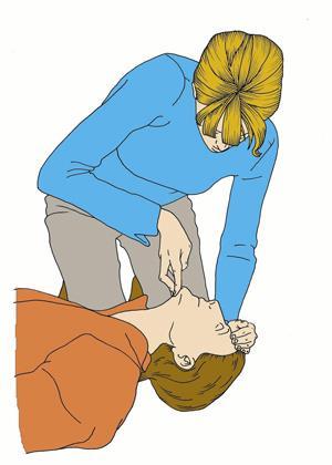 3b. Jeżeli nie reaguje: głośno zawołaj o pomoc, odwróć poszkodowanego na plecy, a następnie udrożnij jego drogi oddechowe, wykonując odgięcie głowy i uniesienie żuchwy: 1.