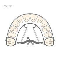 Prace przeglądowe / Reviews Review of maxillary molar distalising appliances with palatal anchorage on mini-implants Rycina 1. BAPA Rycina 2.