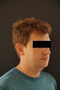 Patient with obstructive sleep apnoea at the orthodontic practice case report Opis przypadku / Case report a a Rycina 1a, 1b. Fotografie zewnątrzustne pacjenta.