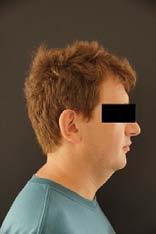 Hypertrophy of tissues in the chin area, increased neck circumference and an anterior position of the head are noticeable. b a Rycina 2a, 2b. Fotografie wewnątrzustne.