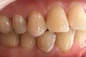 Chipped incisal edges of the upper and lower incisors, cracks in the enamel and tooth abrasion are noticeable. Rycina 3.