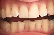 Grade IV according to the Mallampati classification invisible soft palate during the examination. In addition, one can observe the presence of tooth impressions on the tongue. Rycina 4.