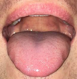 Characteristic incisions of the mandibular body corresponding to massive masseter attachments can be observed. żuchwy (CR) i w maksymalnym zaguzkowaniu.