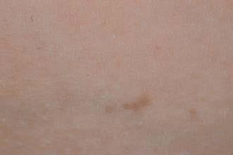 Incontinentia pigmenti a description of three cases Opis przypadku / Case report Przypadek 1.