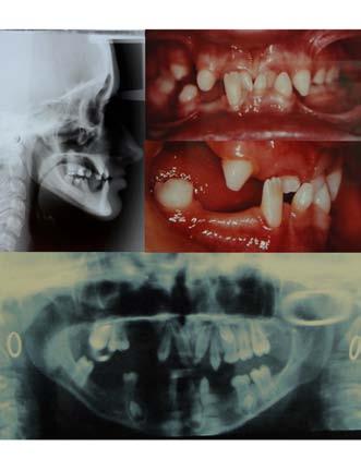 Incontinentia pigmenti a description of three cases Opis przypadku / Case report was referred to a prosthodontics practitioner for further rehabilitation of the masticatory system such as repair of a