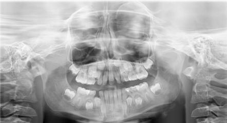 Solitary median maxillary central incisor case report Opis przypadku / Case report Rycina 3. Zdjęcie pantomograficzne. Figure 3. Panoramic radiography. Rycina 4.