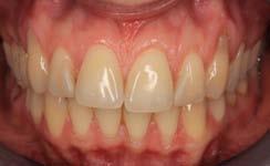 Opis przypadku / Case report Gingival recession coverage with a