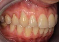 Intraoral pictures before treatment. Right side. Rycina 3.