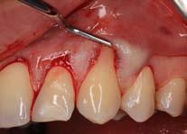 Intraoral pictures before treatment. Left side. Rycina 4.