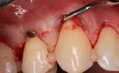 Figure 10. Graft placement in the tunnel. Rycina 11.