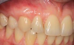 Double-crossed sutures. Rycina 12.