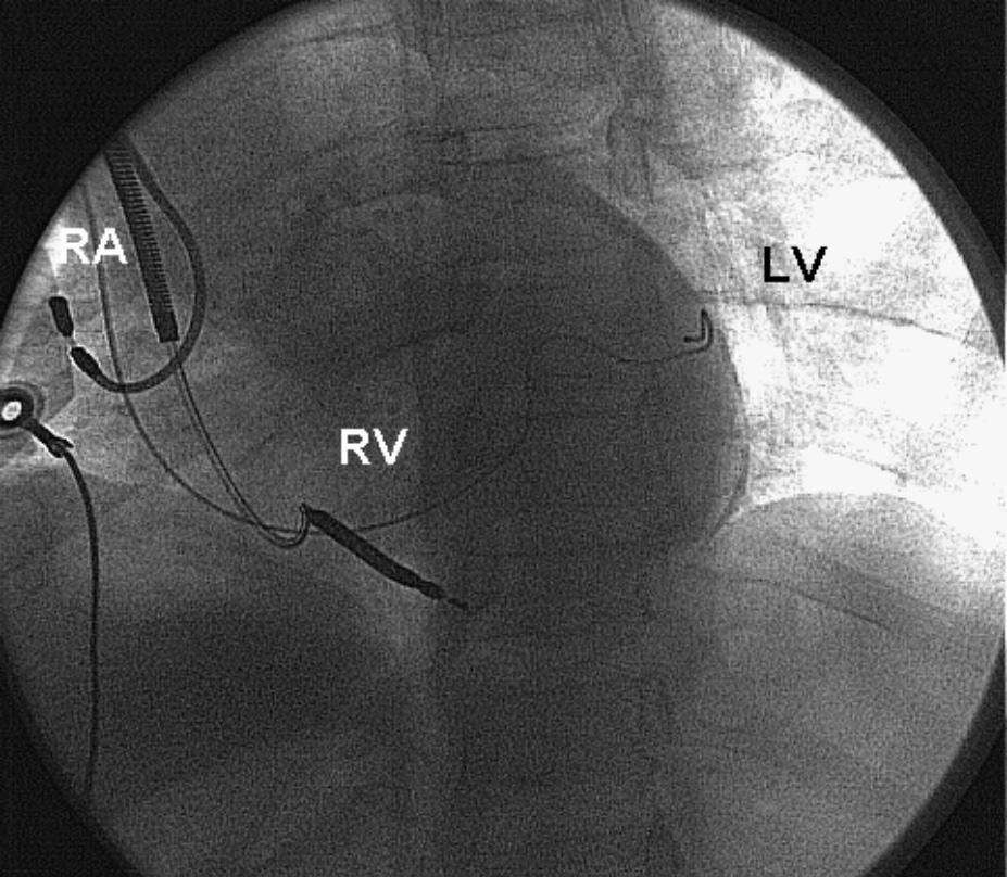 A selective retro-venography of cardiac venous system; 40 o left oblique view; LC leading catheter, CS coronary sinus, PlatV postero-lateral vein, LatV lateral vein, MCV mid cardiac vein Rycina 3.
