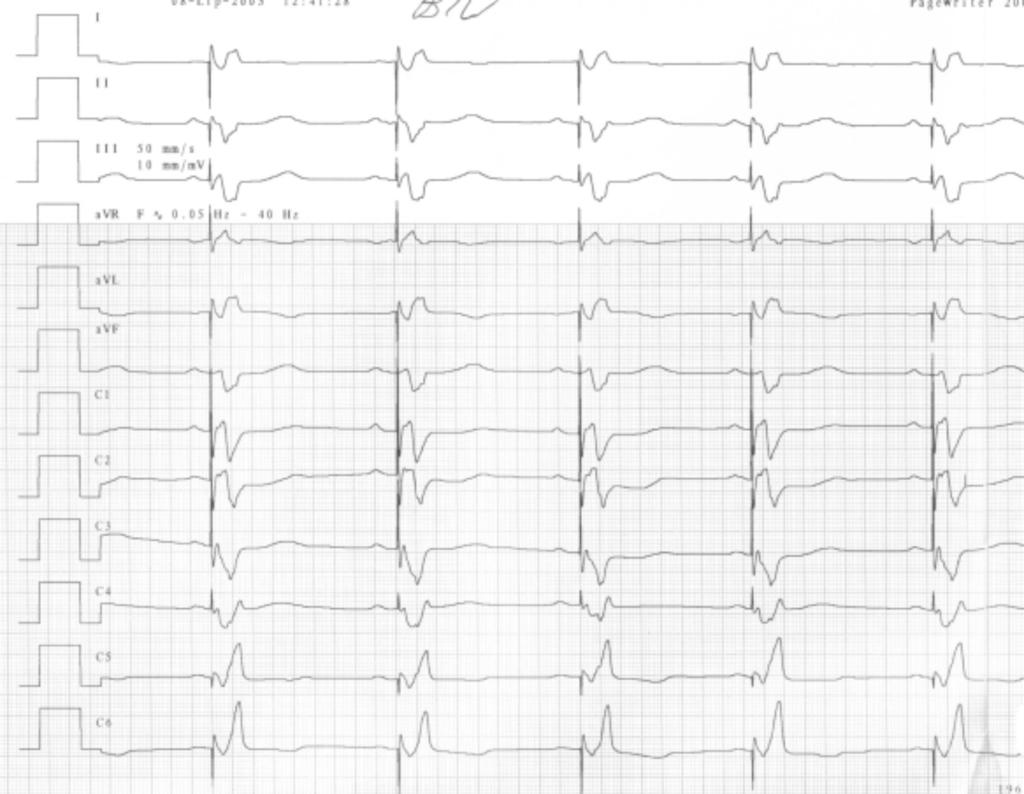 komorową stymulacją resynchronizującą. Skrócenie odstępu QRS z 200 ms do 160 ms. Przesuw papieru 50 mm/s Figure 4.