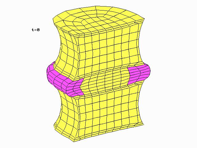 Deformacja dysku L4-L5