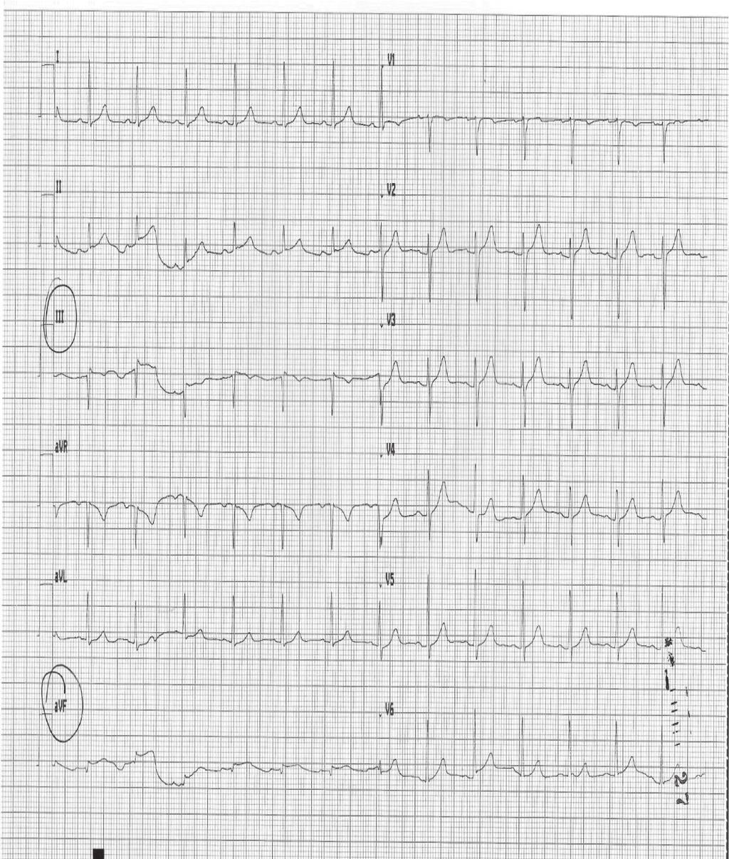 Olga Wajtryt i wsp. Ryc. 1. Zapis elektrokardiogramu w drugiej dobie po przyjęciu do szpitala. Rytm zatokowy o częstości 80/ min. PQ 0,16, QRS 90 ms, QT/Qtc 362/399.