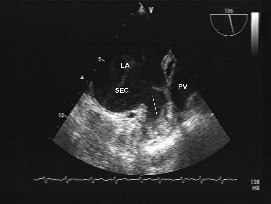 Results: PMC was successful in 38 of patients with left atrial appendage thrombus. One patient required emergency surgery because of significant mitral regurgitation.