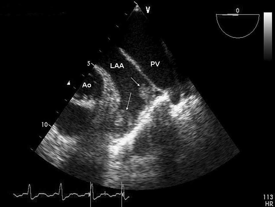1 mmhg before and 4.2±1.5 mmhg after PMC, p <0.001), pulmonary artery systolic pressure (50.9±17.5 mmhg before and 39.9±14.9 mmhg after PMC, p <0.001) were observed.