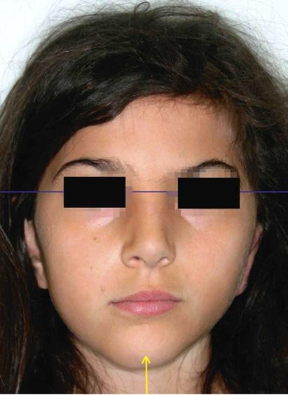 Frontal photographs showing changes in position of the chin point