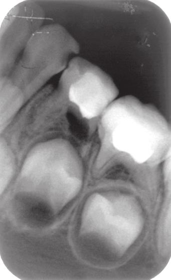 Magazyn Stomat., 2001, XI, 9, 66-69. 6. Goodman J.R.: Endodontic treatment for children. Br. Dent. J., 1985, 158, 363-367. 7. Daszkowska M.
