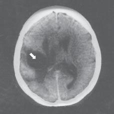 Radiation complications following surgical irradiation of malignant brain glioblastoma 63 Analysis of the radiological documentation of the patients demonstrated, that the early postradiation lesions
