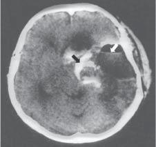 (63 %) Thrombosis in the postsurgery 9/16 (56 %) Subdural hematoma 8/16 (50 %) Blood in the ventricles 2/16 (13 %) Air vesicles in the cranial cavity 7/16 (44 %) Ischemic lesions 3/16 (19 %) Ischemic