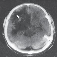 60 B. WINKLER, E. CZEKAJSKA-CHEHAB, D. NYCZ-BODEŃSKA, M. MAZURKIEWICZ Fig. 3. Relapse of glioma in the surgery bed with symptoms of edema and mass effect 3 months following radiotherapy Ryc. 3. Wznowa glejaka w loży pooperacyjnej z objawami obrzęku i efektem masy 3 miesiące po radioterapii Fig.