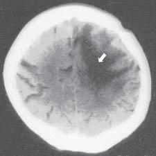 Radiation complications following surgical irradiation of malignant brain glioblastoma 61 Assessment of the lesions associated with the cancer tumor Among the lesions associated with a cancer tumor