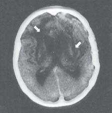The most frequent symptom coexisting with the cancer relapse was brain edema.