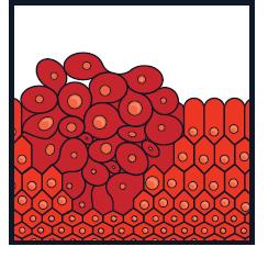 These cells form a lump called a tumour. Normal cells Cells forming a tumour Not all lumps are cancer. A lump that is not cancer is called benign. It cannot spread to anywhere else in the body.