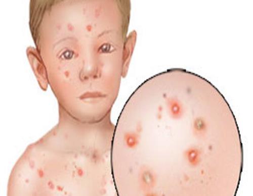 Od roku 2013 na terenie miasta Siemianowice Śląskie nie zarejestrowano żadnego przypadku zachorowania na odrę oraz poliomyelitis (nagminne porażenie dziecięce).