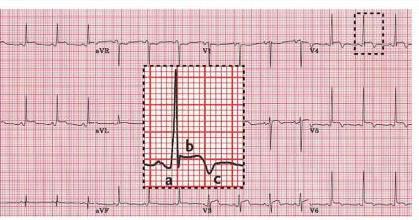 Zapalenie osierdzia EKG uniesienie odcinka ST w wielu