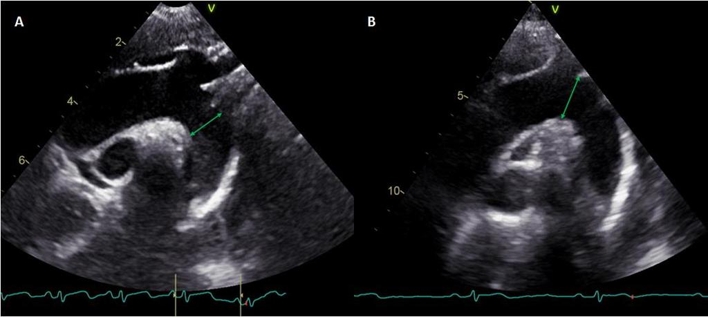 łuk aorty Łuk aorty obrazowano w projekcji nadmostkowej, w której uzyskiwano przekrój podłużny aorty.