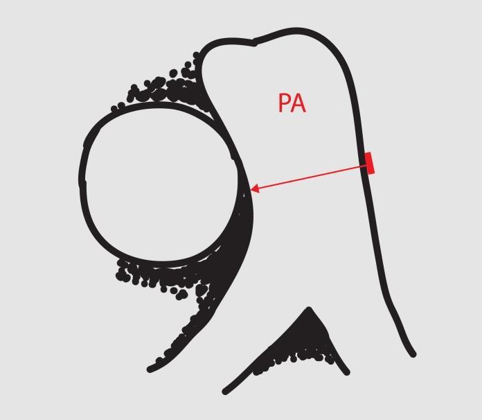 Rycina 14. Wymiarowanie średnicy pnia płucnego.