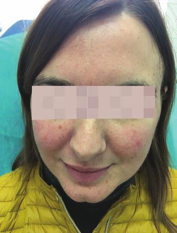 Ryc. 1. Pacjentka 57-letnia, rumień skóry policzków, nosa, brody i czoła. Ryc. 2. Pa cjent ka 29-let nia, drob ne te le an giek - ta zje skóry po licz ków, ru mień skóry po licz ków.