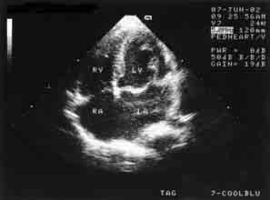 The anteriolateral mitral valve leaflets prolapse in a left atrium direction (LA) Rycina 5. Badanie echo techniką M-mode przekrój w osi długiej przymostkowej.