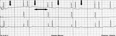 Gwiazdką zaznaczono pseudoekstrasystolię nadkomorową wystymulowane pobudzenie przedwczesne. Fig. 7. AAI pacemaker (60/min). Malfunction of the sensing triggers pseudo atrial premature beats and SVT.