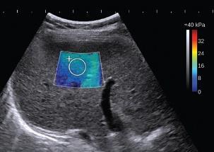 Pacjent Dalsza diagnostyka: HCV DNA - 2 miliony kopii/ml surowicy Genotyp