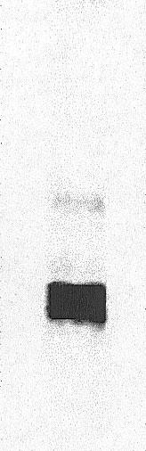 Utratê materia³u genetycznego na d³ugim ramieniu chromosomu 22 wykazano w piêciu przypadkach (rdzeniak, dwa spnet i dwa AT/RT).