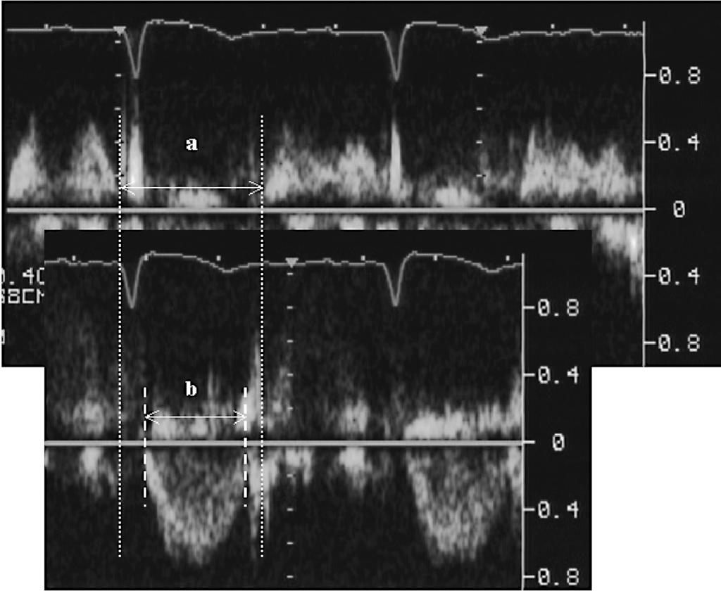 Folia Cardiologica Excerpta 2006, tom 1, nr 2 możliwych do interpretacji obrazów echokardiograficznych.