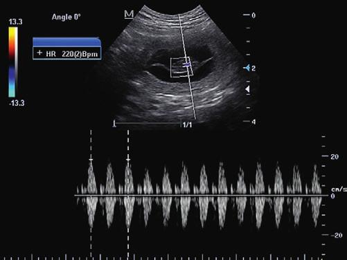 czasie. HR wynosi 208 BPM; Ryc. 14. Badanie elastograficzne guza śledziony. Obraz badanych struktur jest kodowany kolorem.