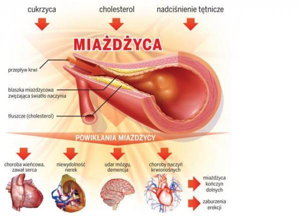 miażdżycowe choroby serca i naczyń pozostają główną przyczyną przedwczesnych zgonów na całym świecie; występują zarówno u mężczyzn,