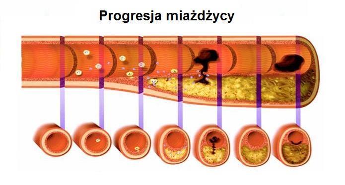 miażdżycowe choroby serca i naczyń/choroby układu sercowo-naczyniowego są przewlekłymi chorobami rozwijającymi się