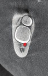 Rozdzielczość endodontyczna Skan w trybie niskiej dawki (LDT)