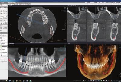 Standardowy, segmentacja, pediatryczny, stawy skroniowo-żuchwowe, zdjęcia skrzydłowo-zgryzowe 3D/CBCT Odbiornik obrazu CMOS Wielkość woksela obrazu 80 400 μm Napięcie lampy 95 kv Prąd lampy 2 12.