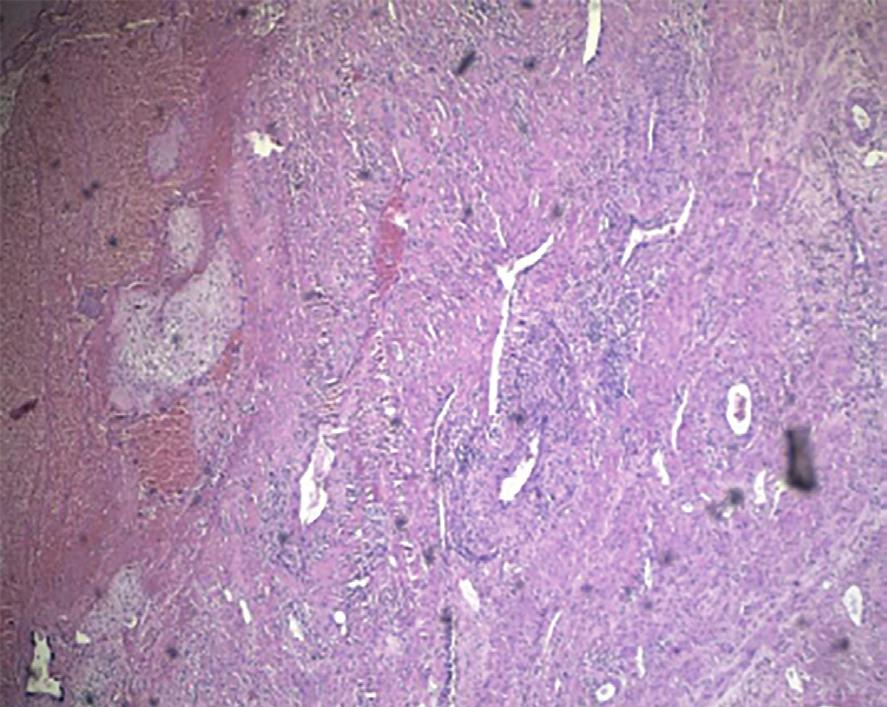 Mikroskopowo kosmki łożyska obserwowane w obrębie ściany macicy i głęboko wnikające w jej mięśniówkę u pacjentki B łożysko wrośnięte (powiększenie 40, hematoksylina-eozyna) Abstract In recent years,