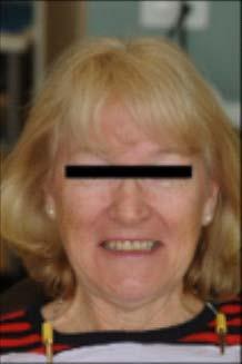 4 Opłucz i wysusz tkankę, a następnie nałóż koferdam w płynie, aby pokryć tkankę miękką. (patrz Fig. 1). Upewnij się, że nie ma przecieków. Utwardź koferdam światłem.