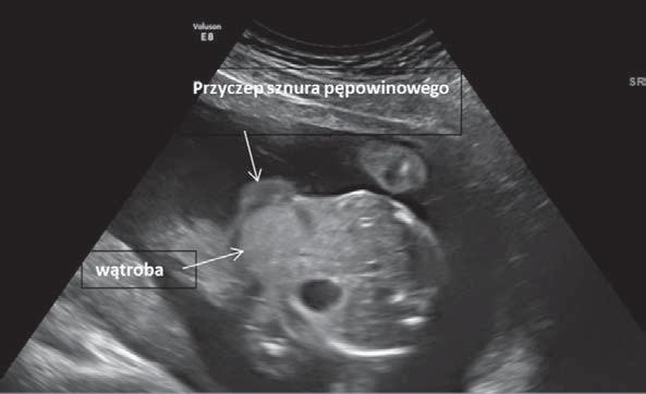 A. Wojtowicz et al. Diagnostyka prenatalna rzadkiego przypadku wynicowania steku w drukarni. Pierwsze badanie USG płodu wykonano w 19+6 tygodniu ciąży.