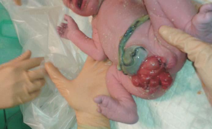 minucie uzyskał 10 punktów w skali Apgar. Po urodzeniu potwierdzono prenatalnie podejrzewaną wadę (ryc.5.).