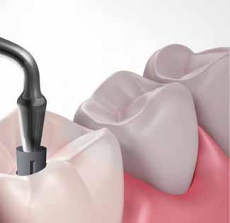 SilverPlug znacząco zmniejsza występowanie periimplant mucositis. Zdrowsze dziąsła zapewniają skuteczniejszą ochronę przed periimplantitis.